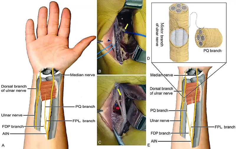 Ulnar nerve decompression and transposition with supercharged end-to-side motor nerve transfer for advanced cubital tunnel syndrome.
